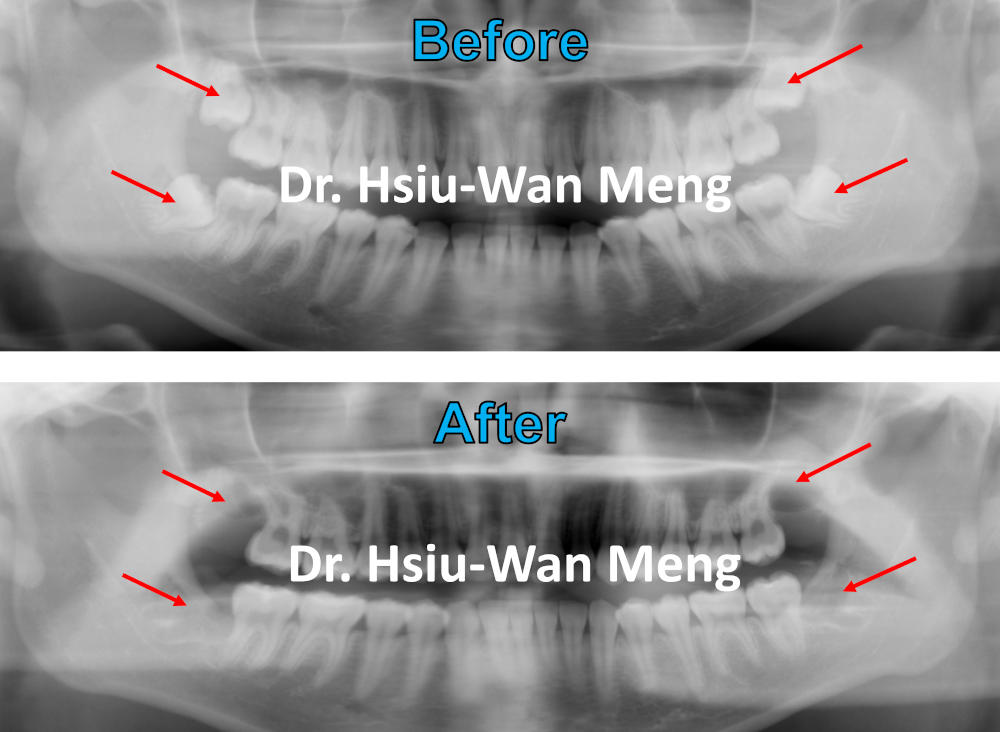 Wisdom Teeth Extraction 2